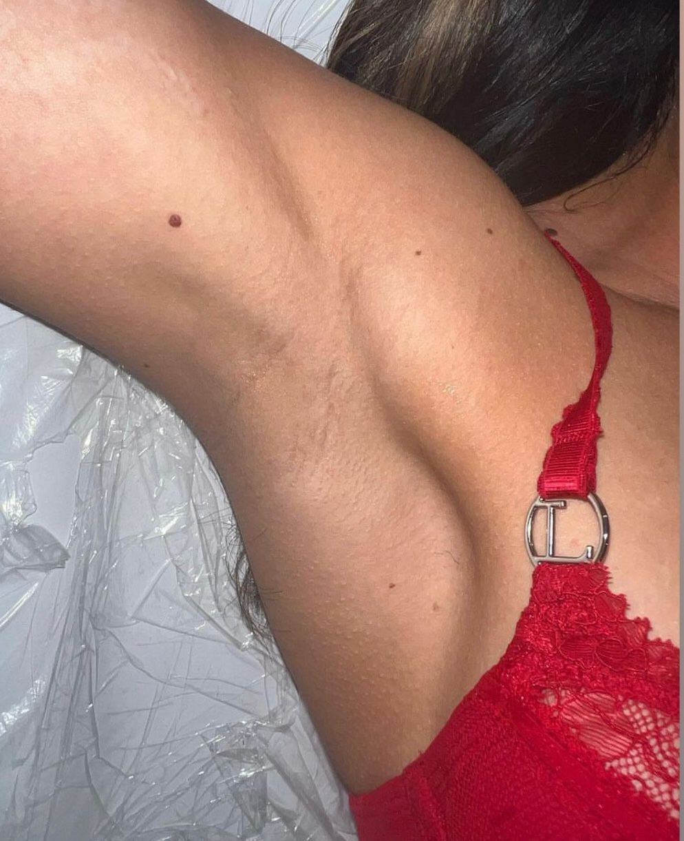Laser Hair Removal