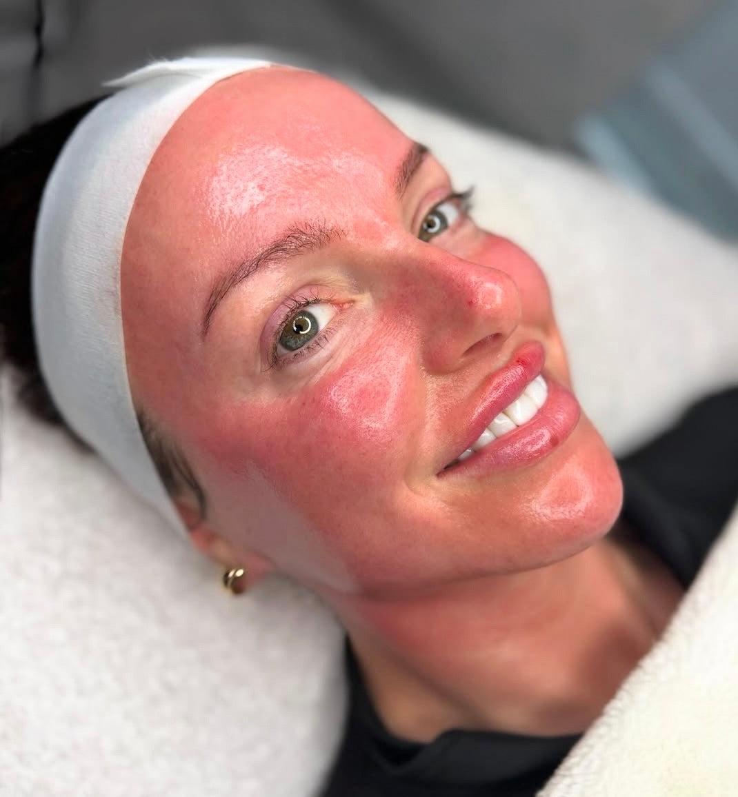 Dermaplaning + Enzyme or Chemical Peel