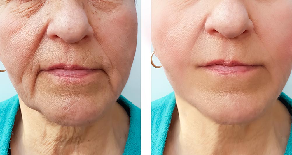 Marionette Lines Treatment with Dermal Fillers