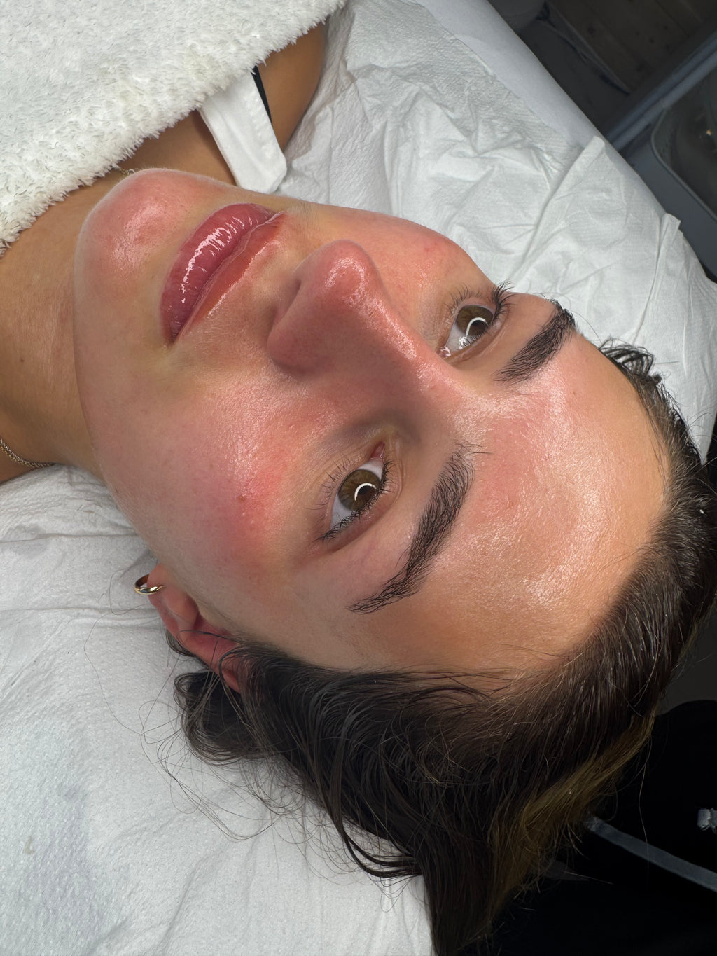 Bioneedling (biorepeel & microneedling)