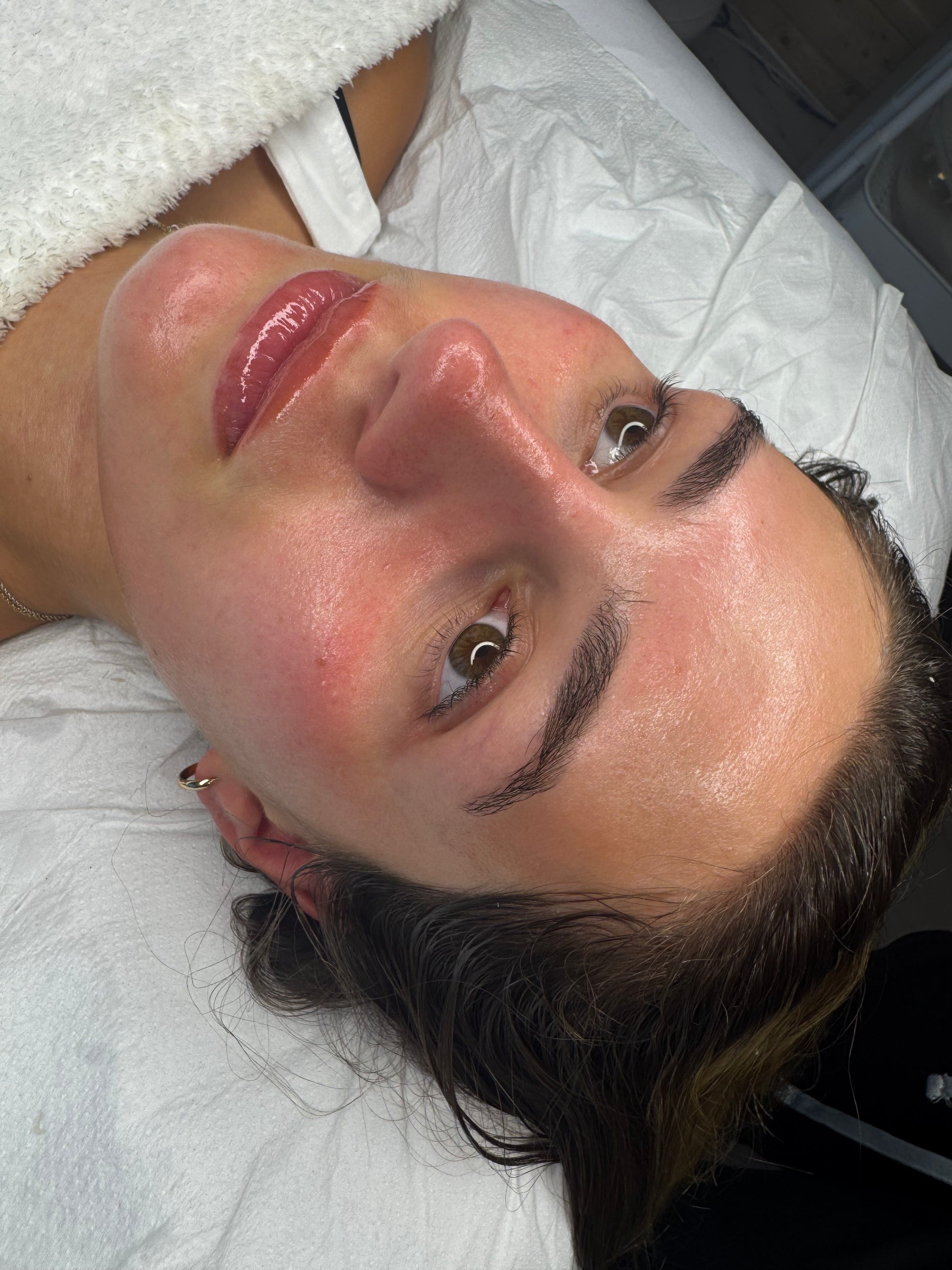 Bioneedling (biorepeel & microneedling)