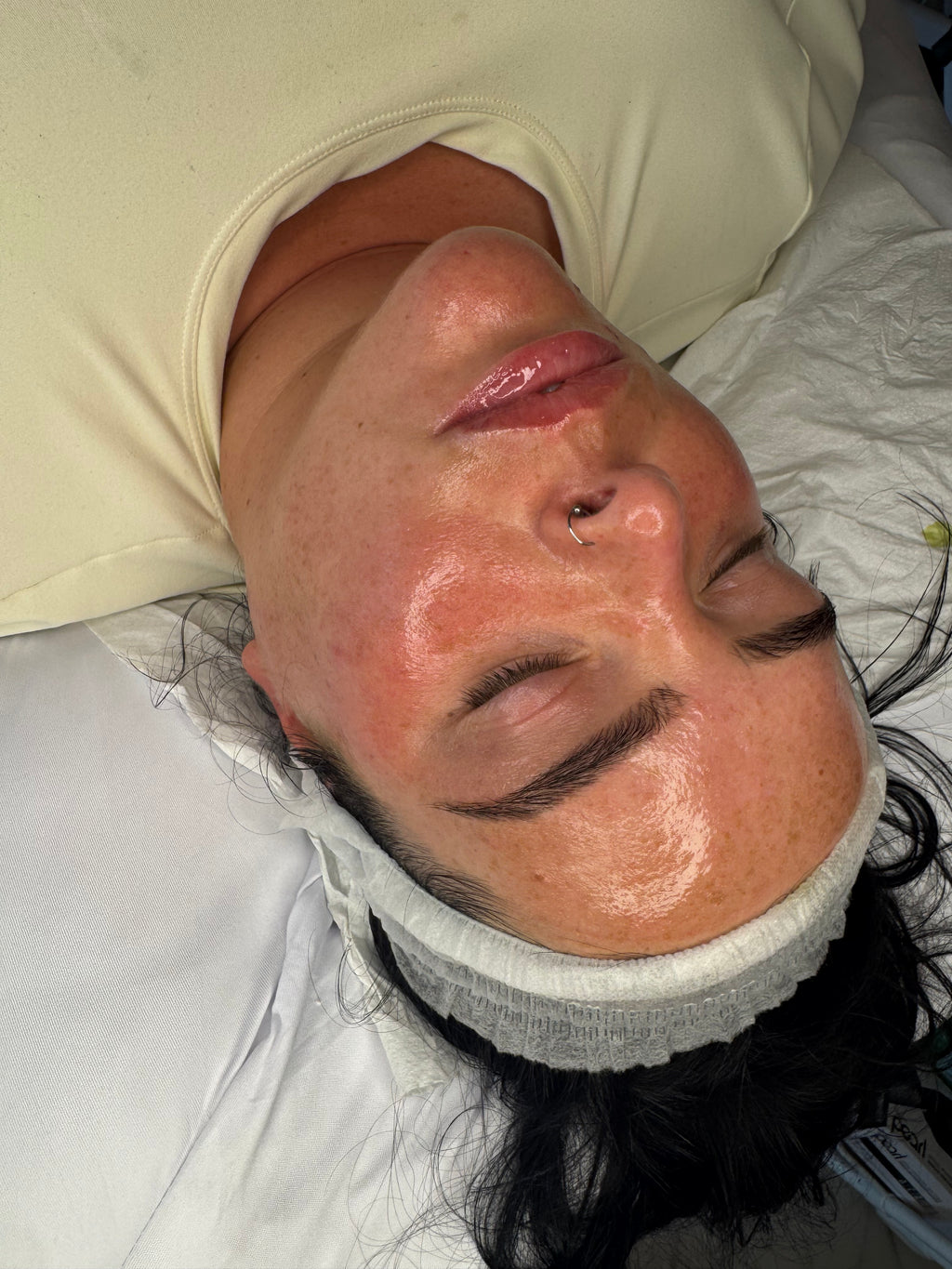 Microneedling + chemical peel/booster/exosomes