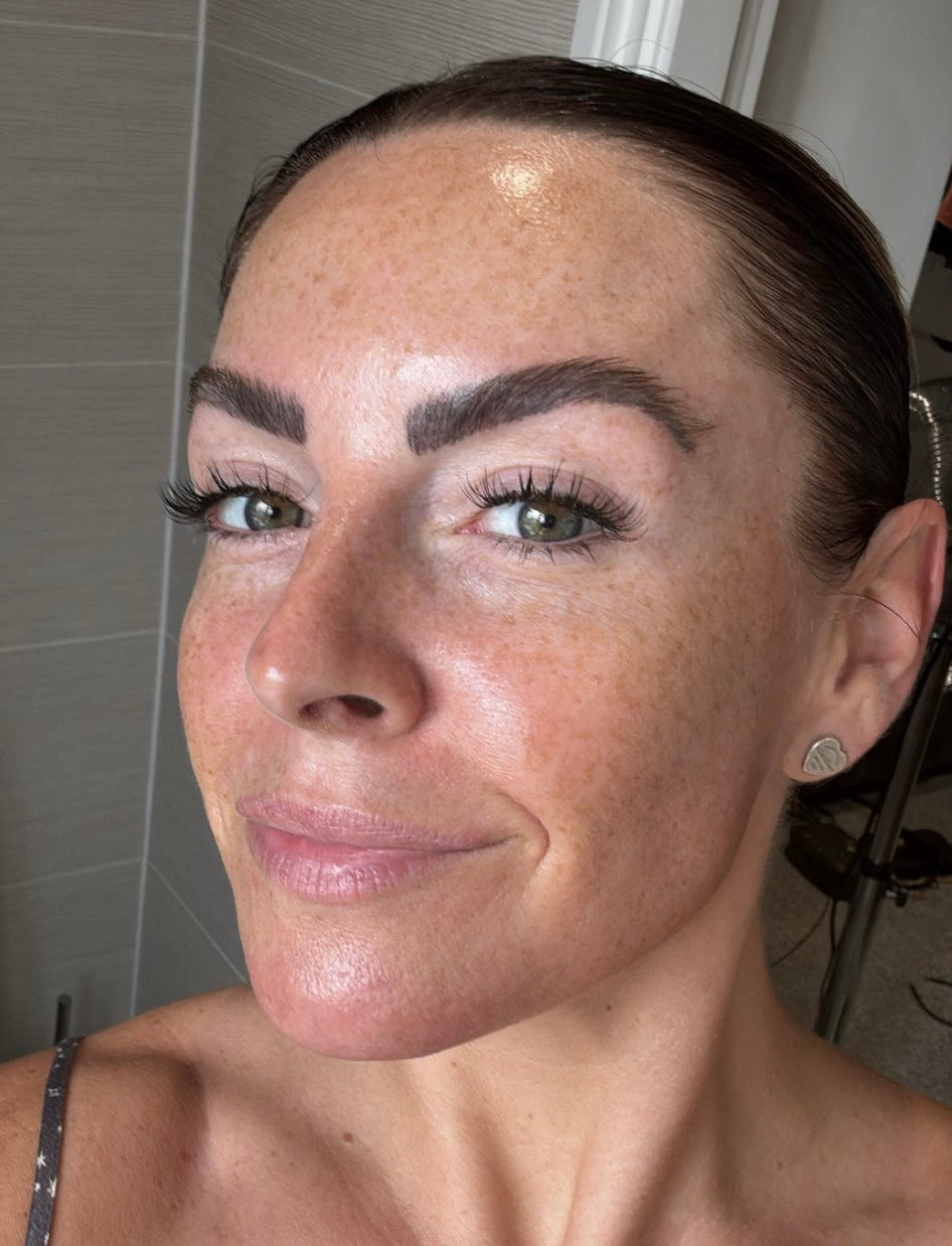 Microneedling Treatment