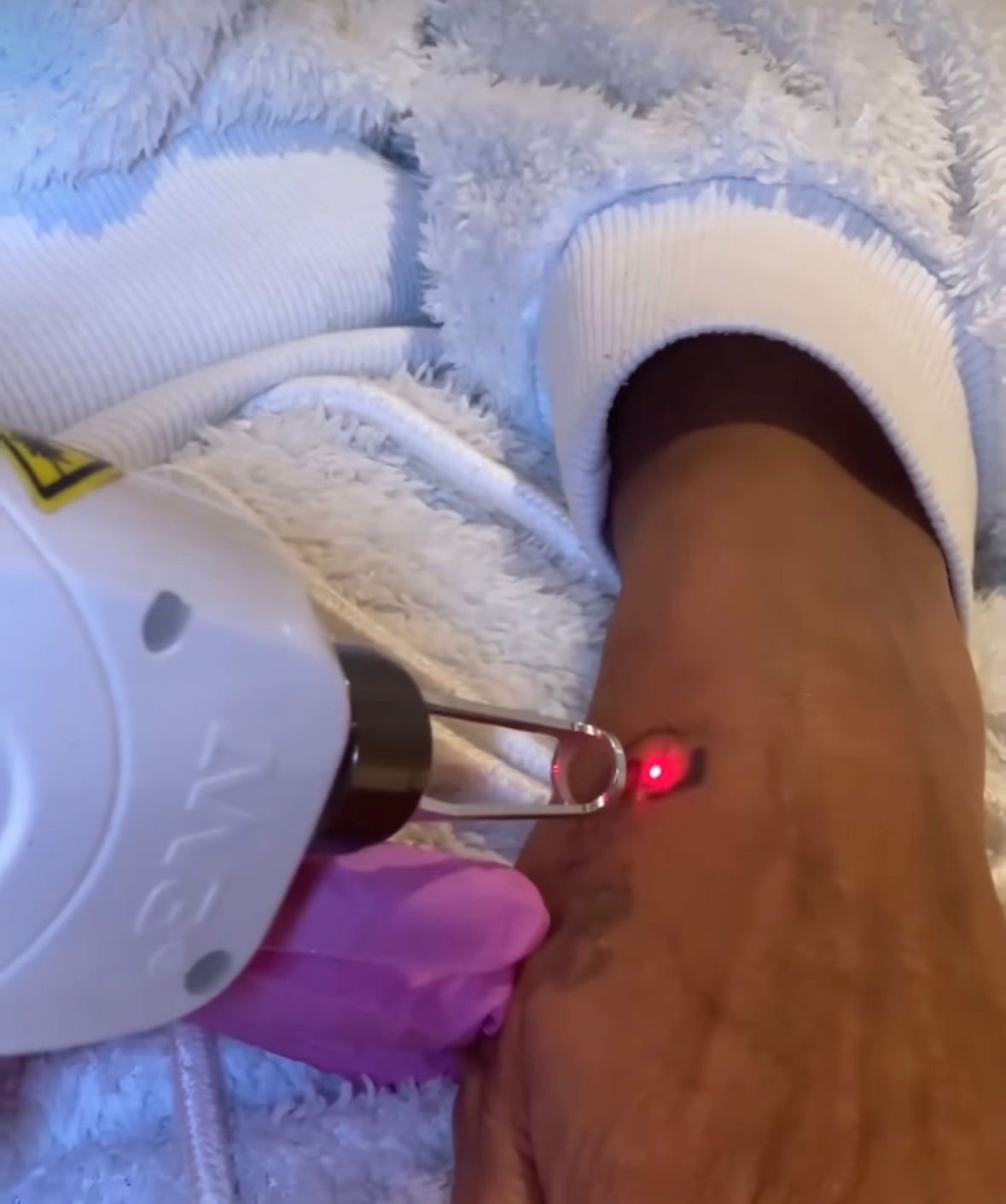 Tattoo Removal