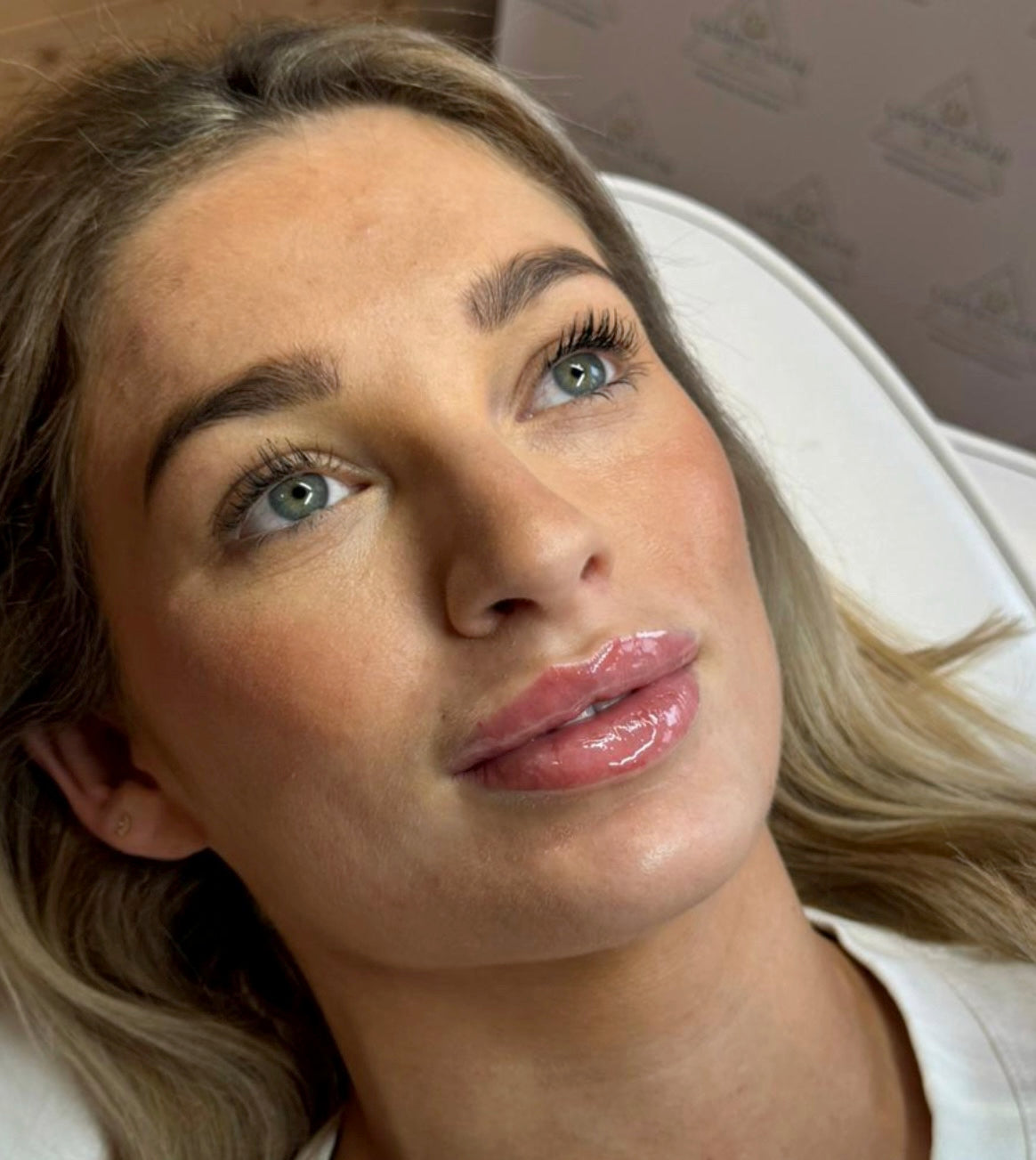 Lip Filler – 0.5ml