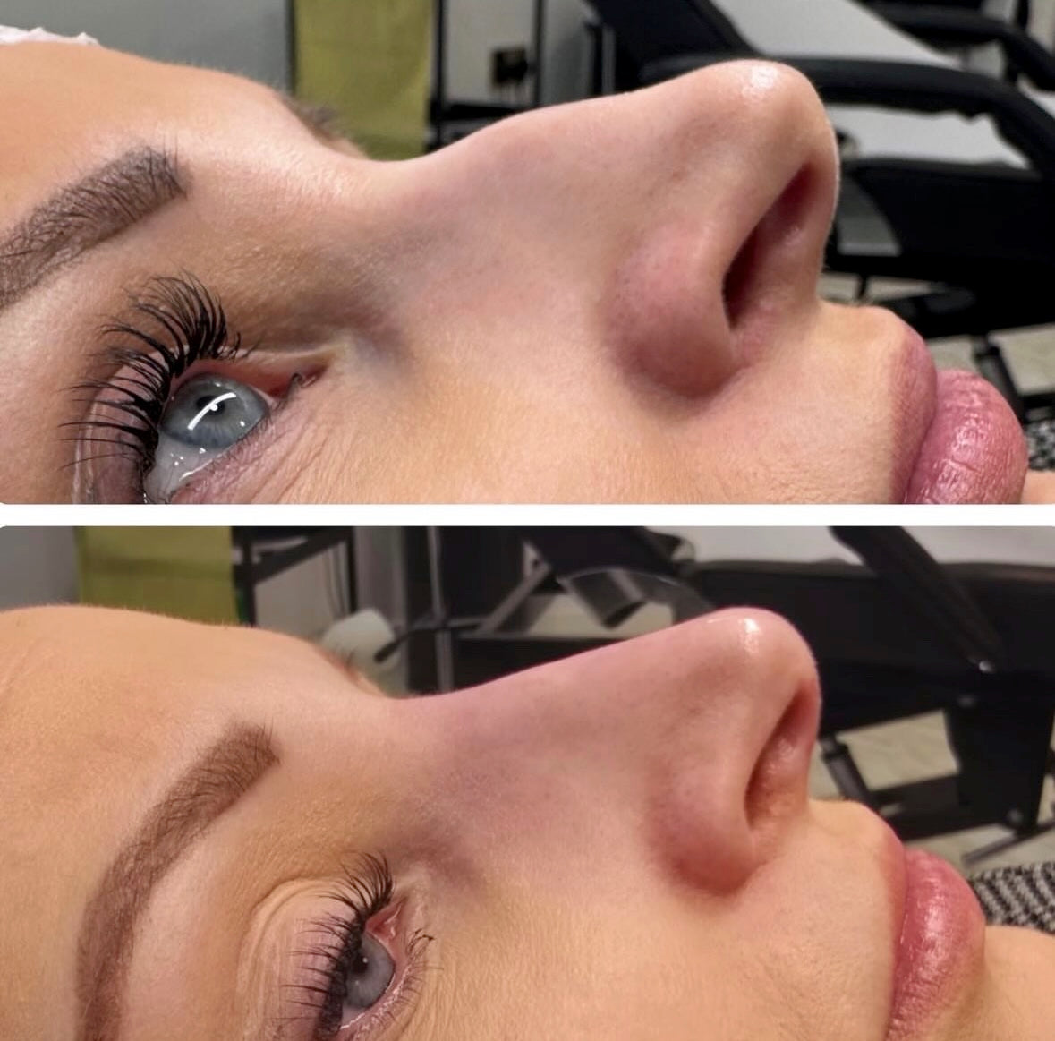 Non Surgical Rhinoplasty