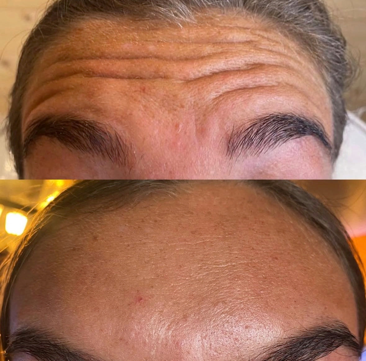 3 Areas Anti-Wrinkle Injection