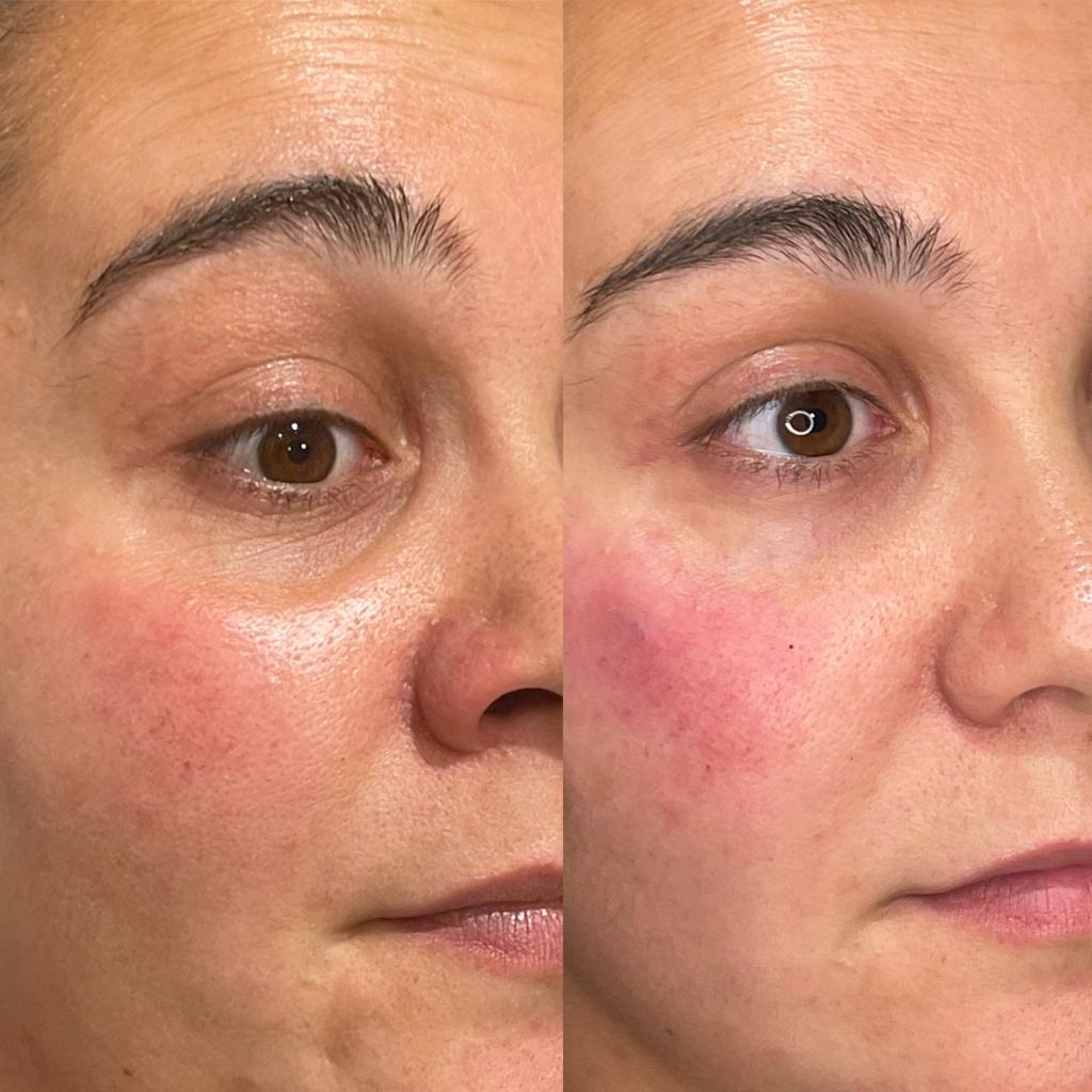 Tear Trough Filler