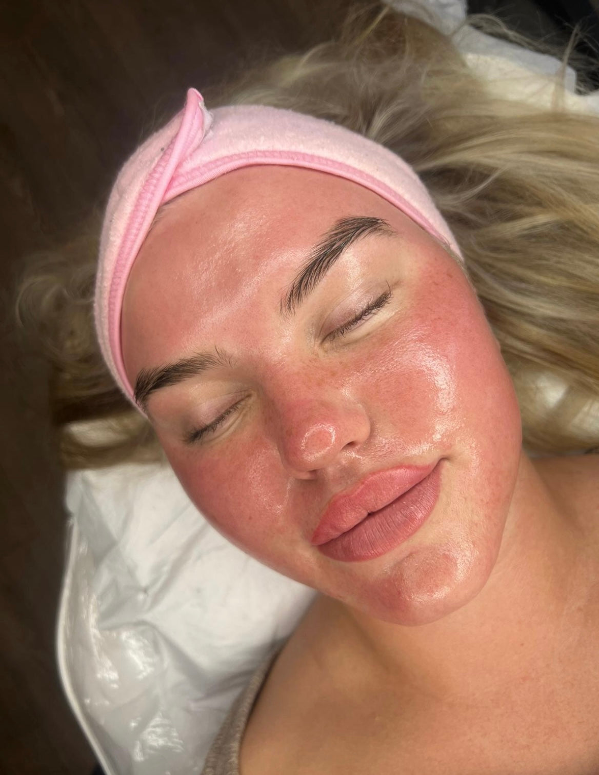 Microneedling + Dermaplaning