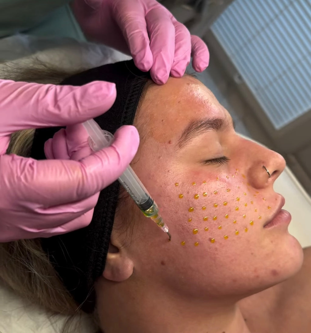 BioRePeel Chemical Peel