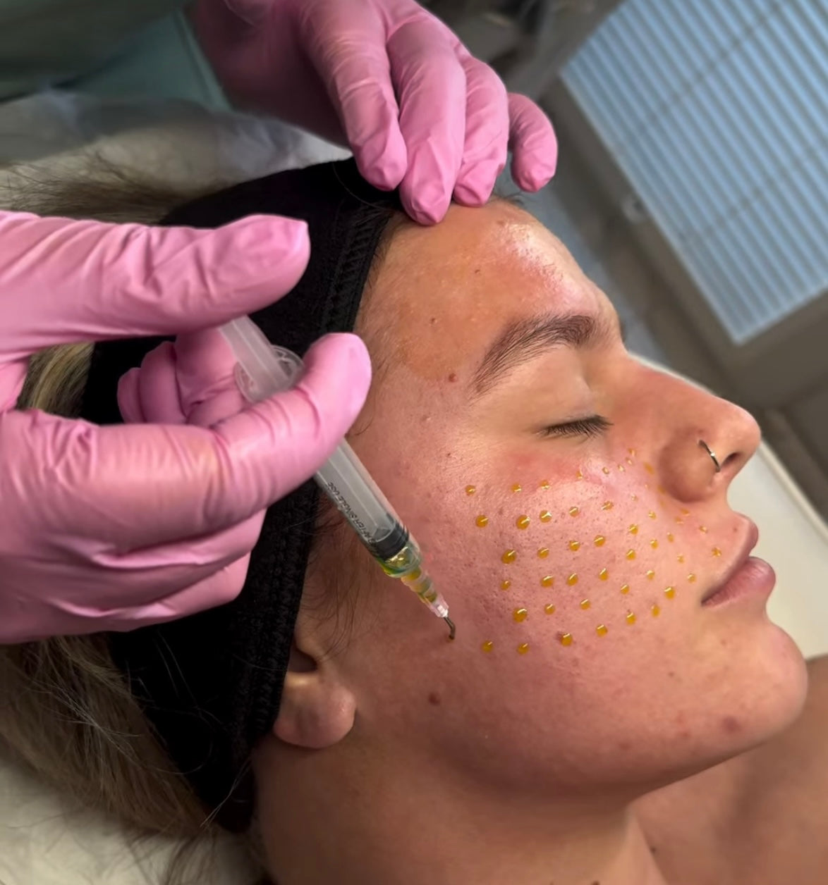 BioRePeel Chemical Peel