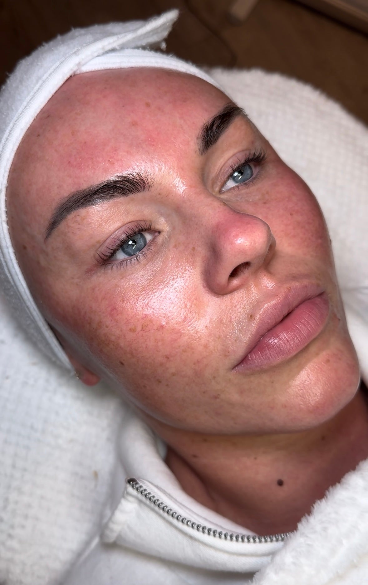 Dermaplaning + Enzyme or Chemical Peel
