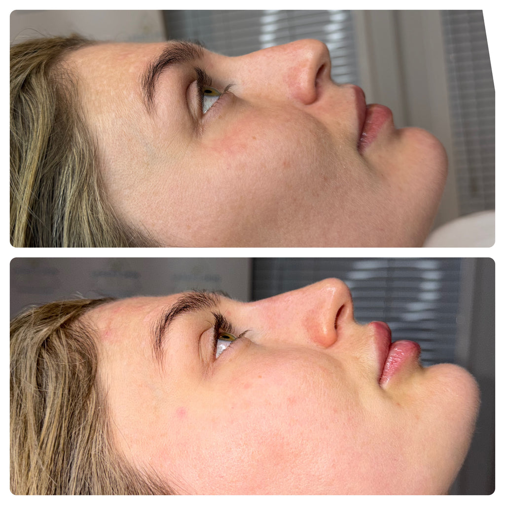 Non Surgical Rhinoplasty
