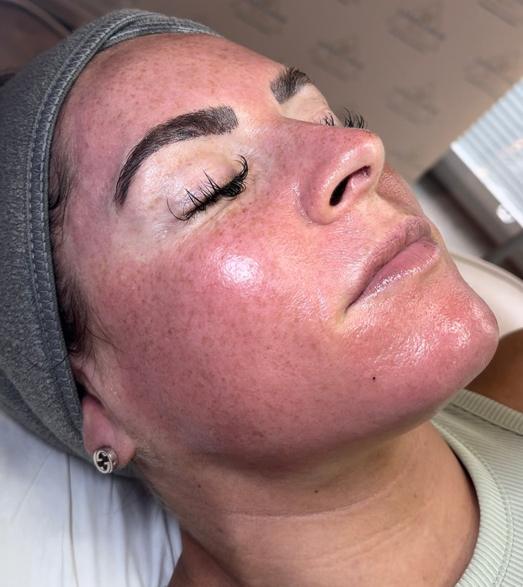 PRP Vampire Facial