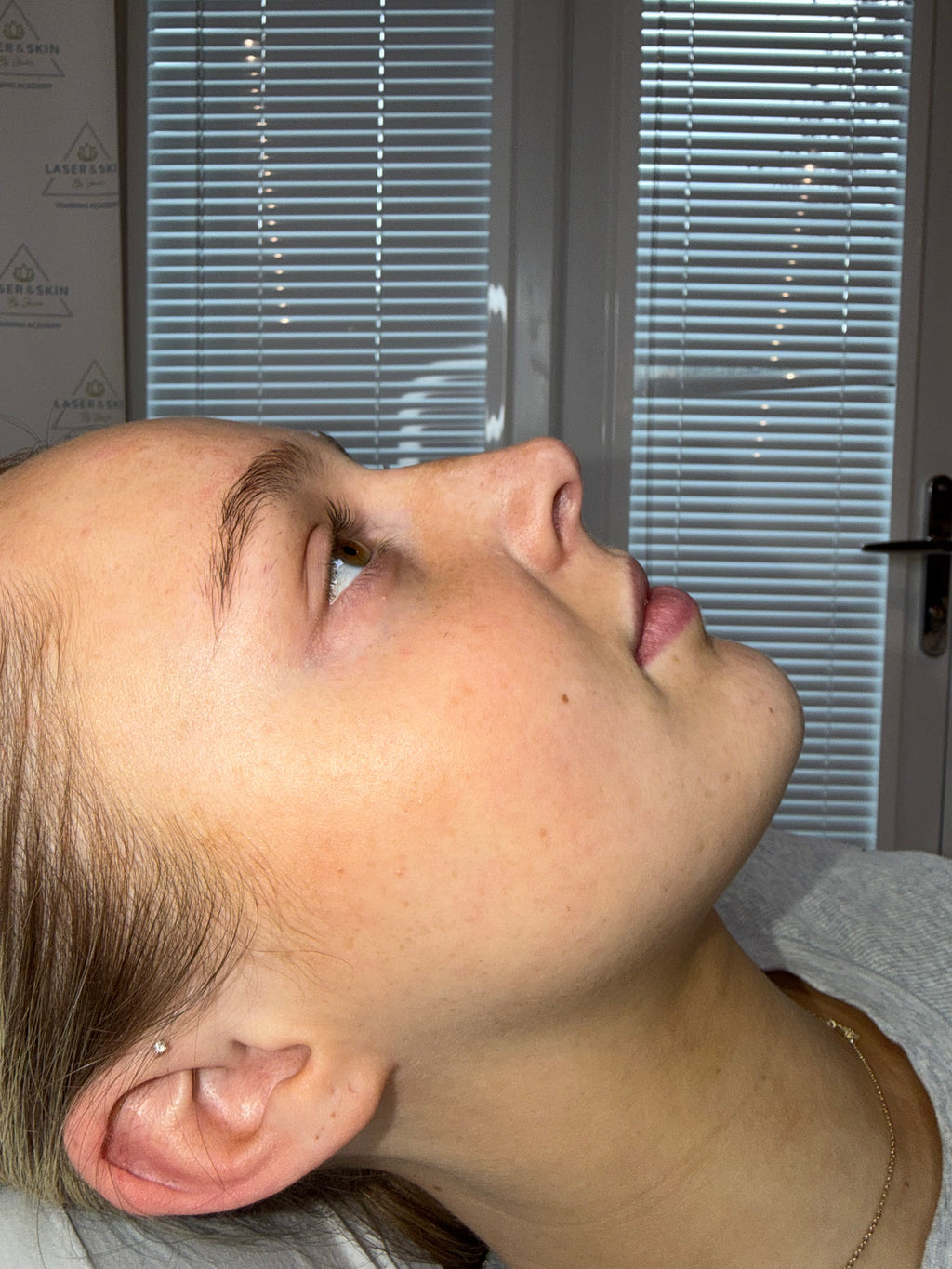 Non Surgical Rhinoplasty