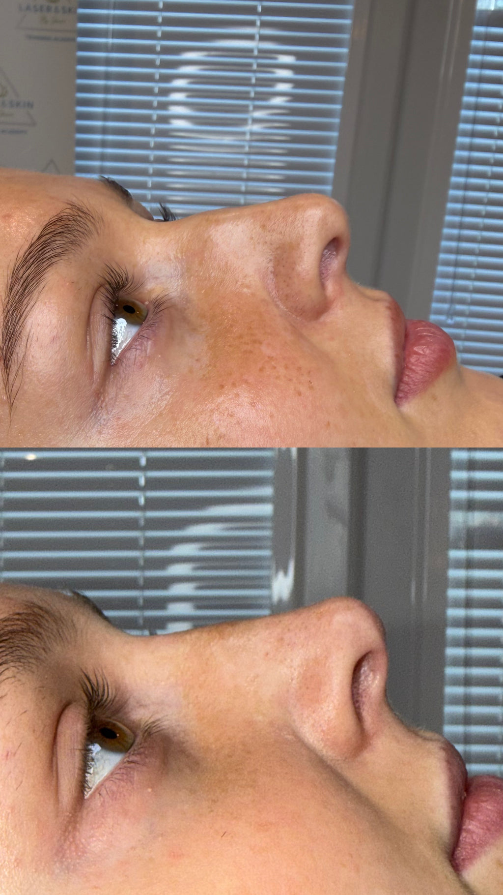 Non Surgical Rhinoplasty