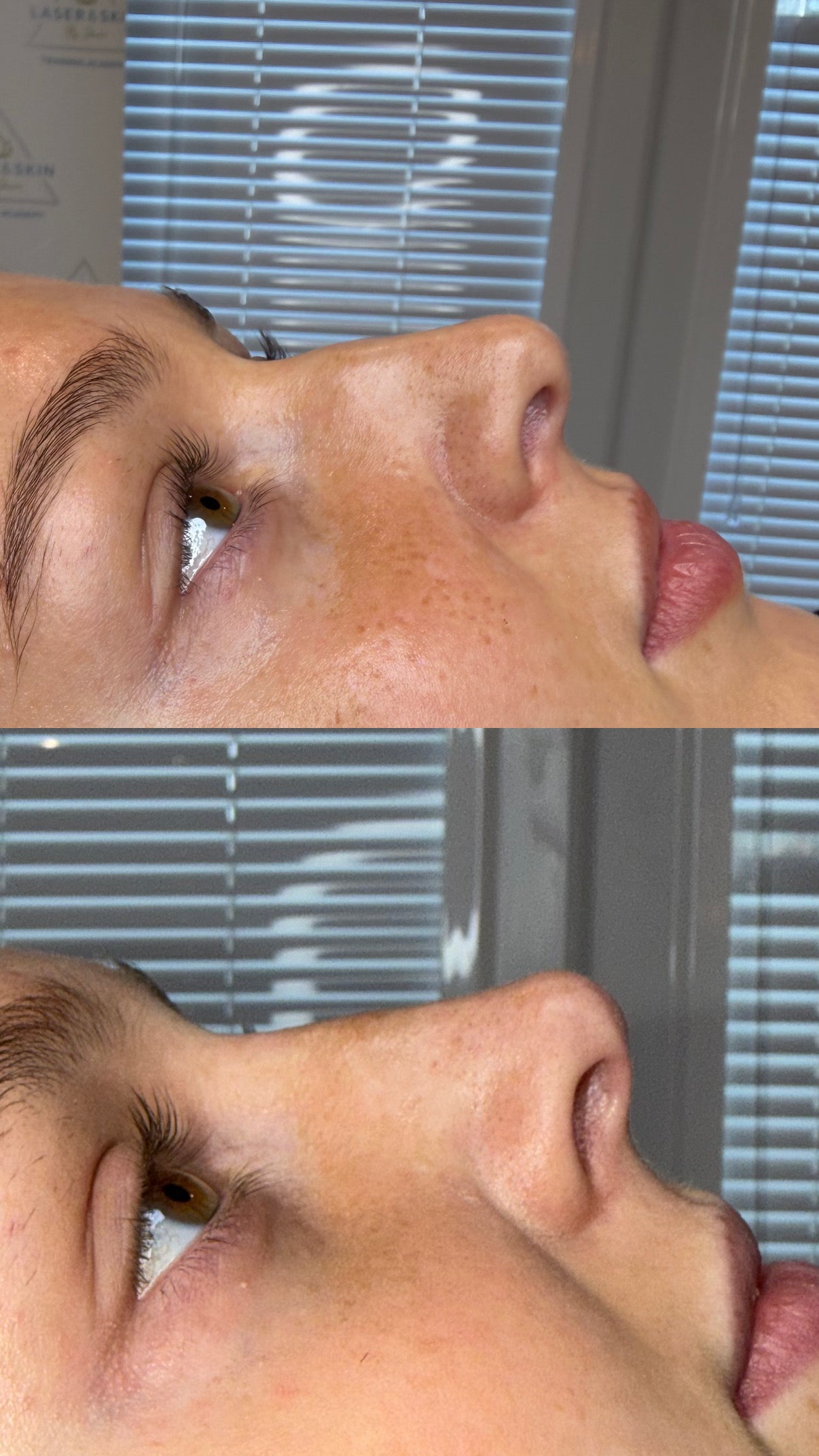 Non Surgical Rhinoplasty