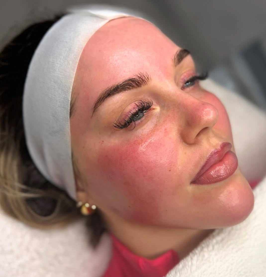 Bioneedling (biorepeel & microneedling)