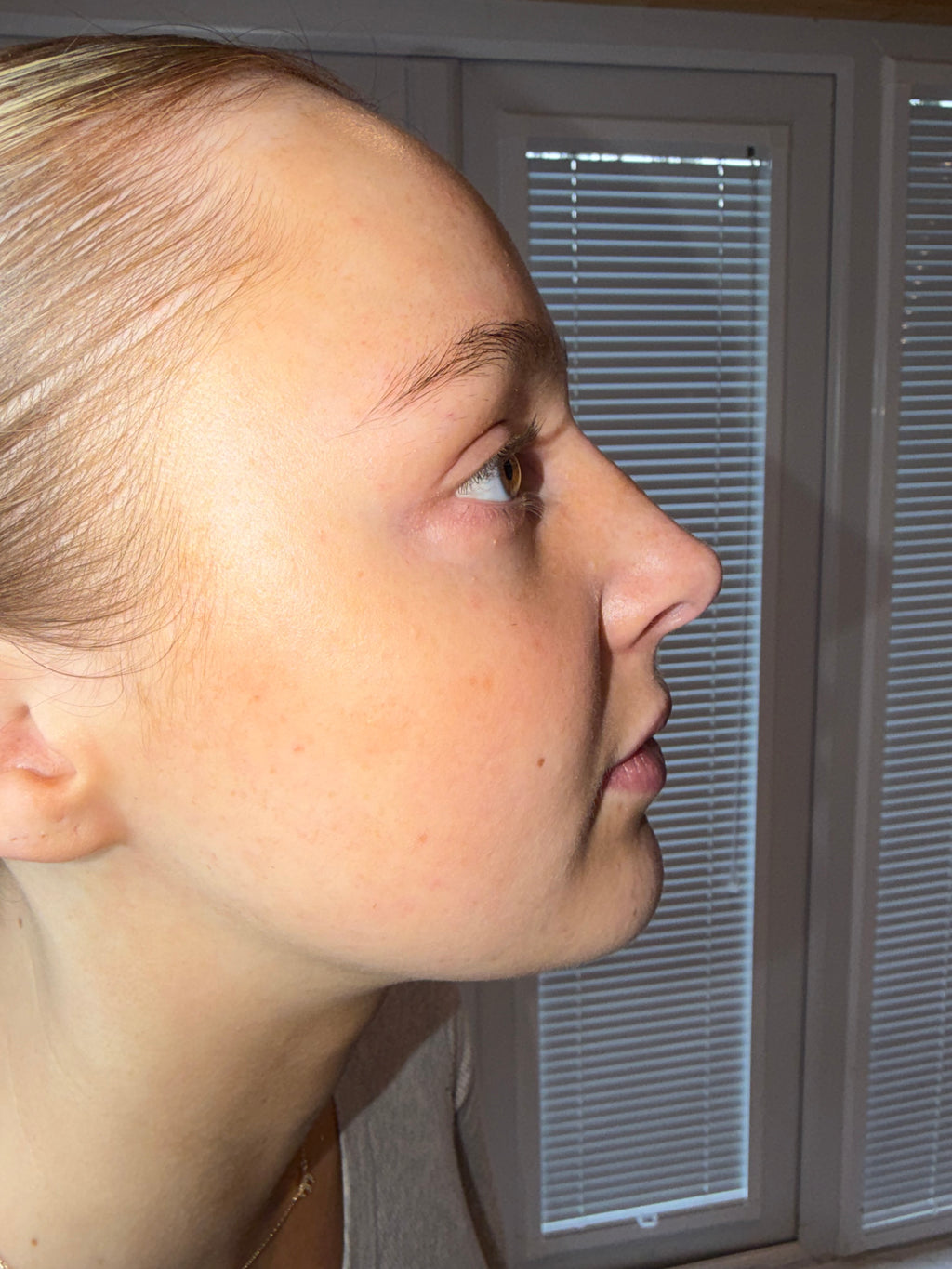 Non Surgical Rhinoplasty