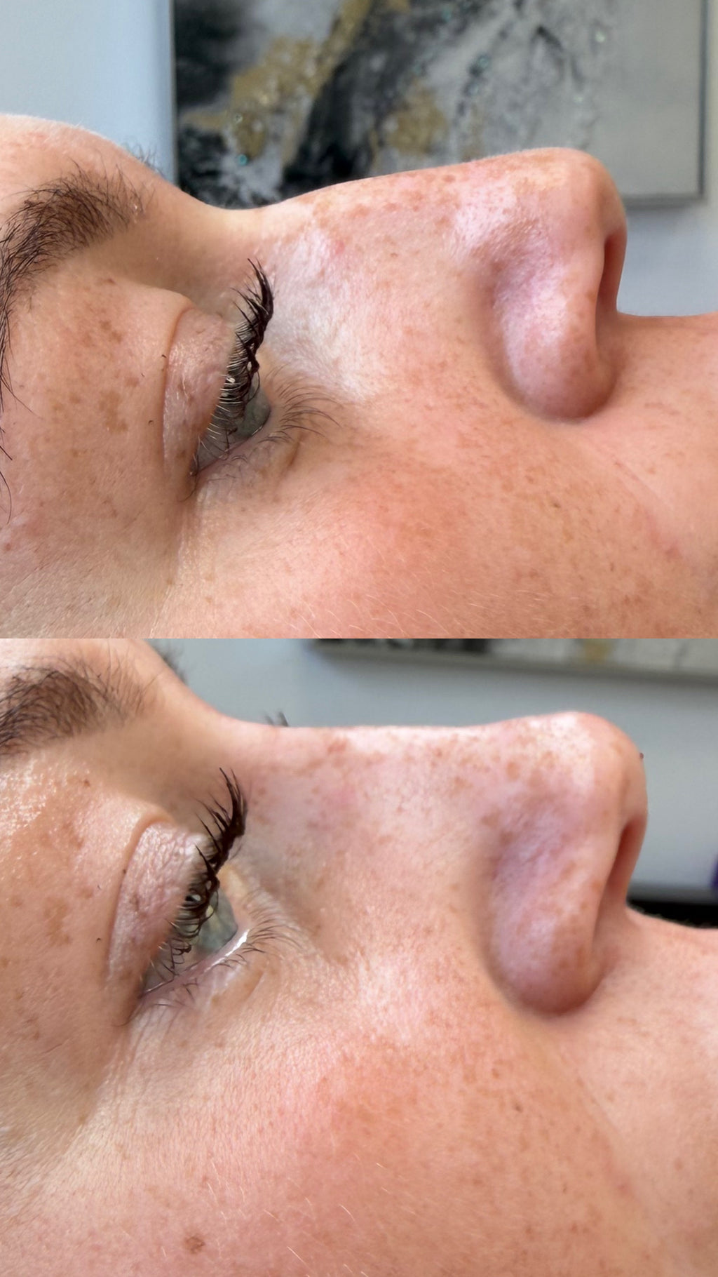 Non Surgical Rhinoplasty