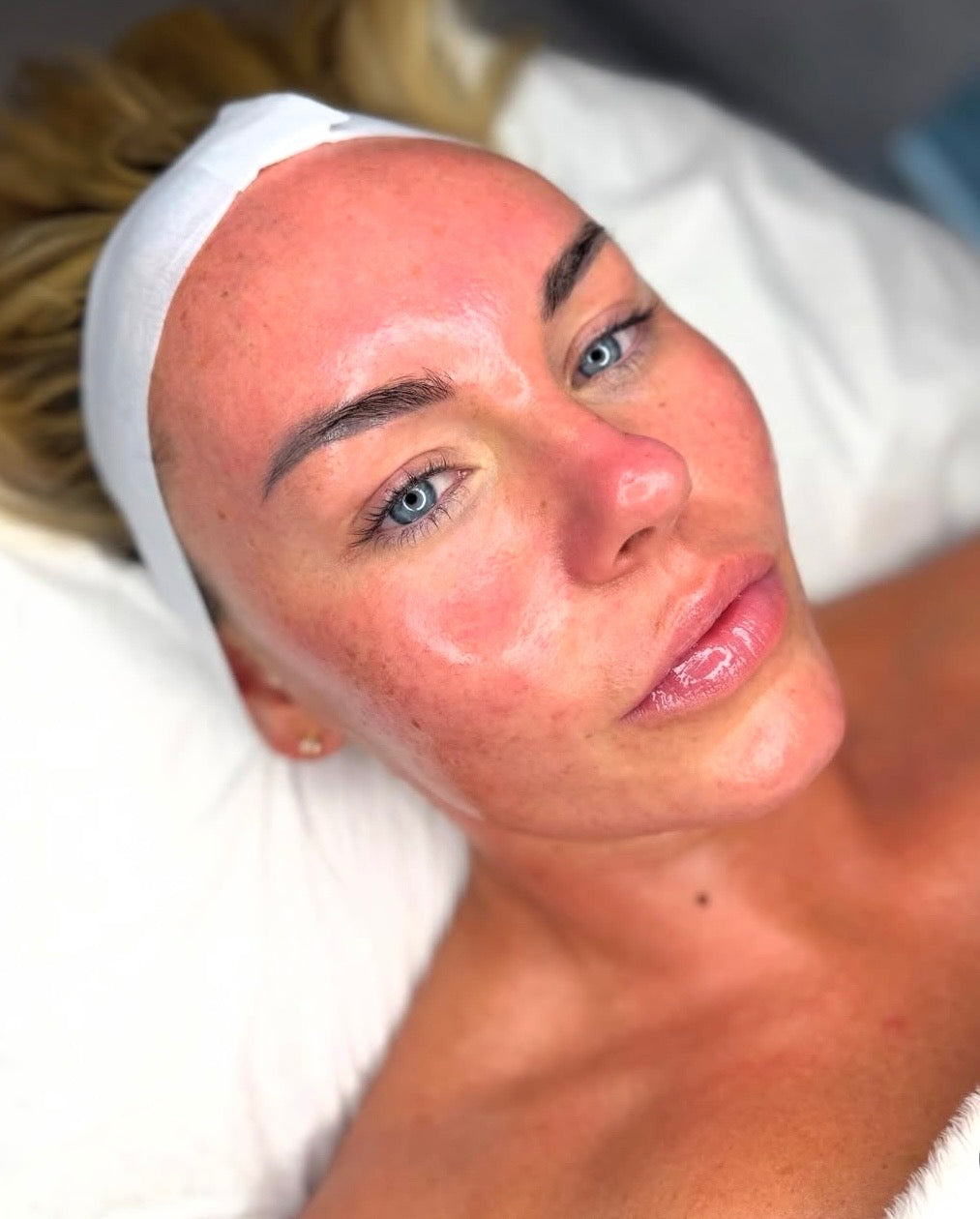 PRP Vampire Facial