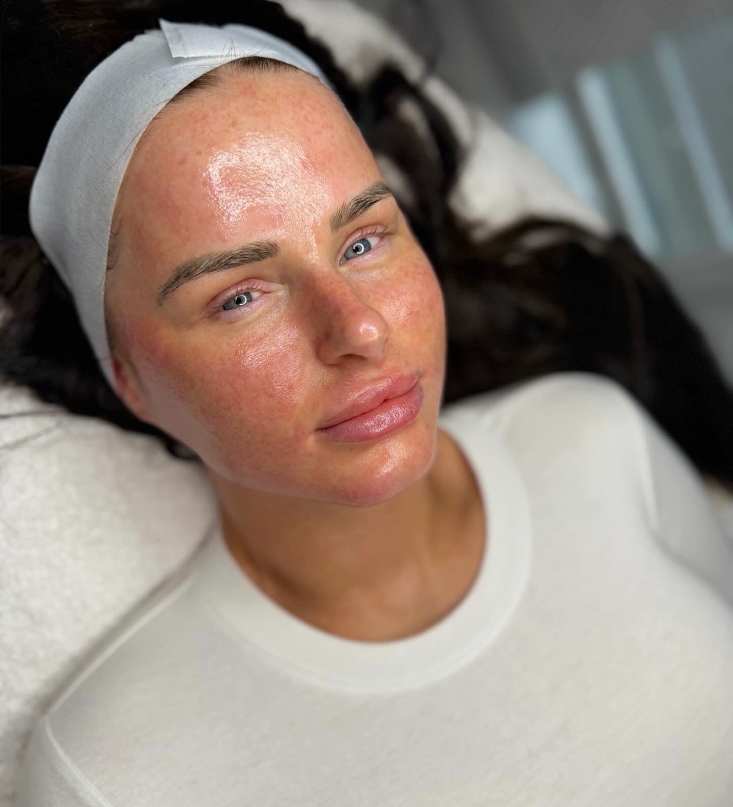 BioRePeel Chemical Peel