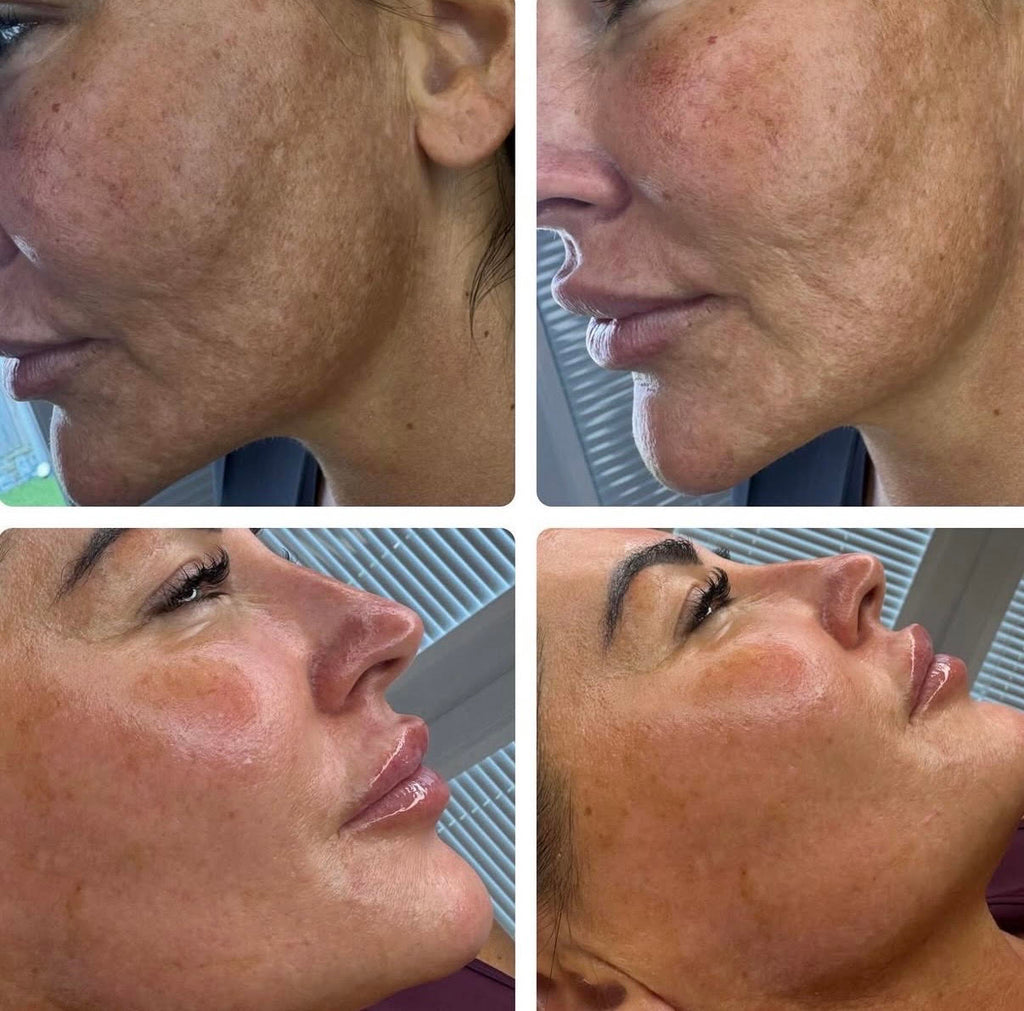 CO2 Fractional Laser Resurfacing