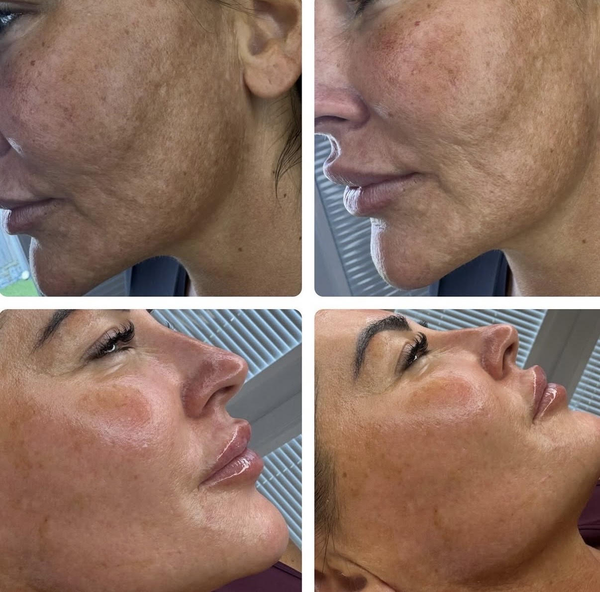 CO2 Fractional Laser Resurfacing