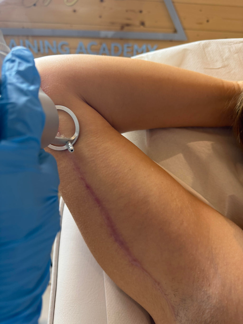 CO2 Fractional Laser Resurfacing
