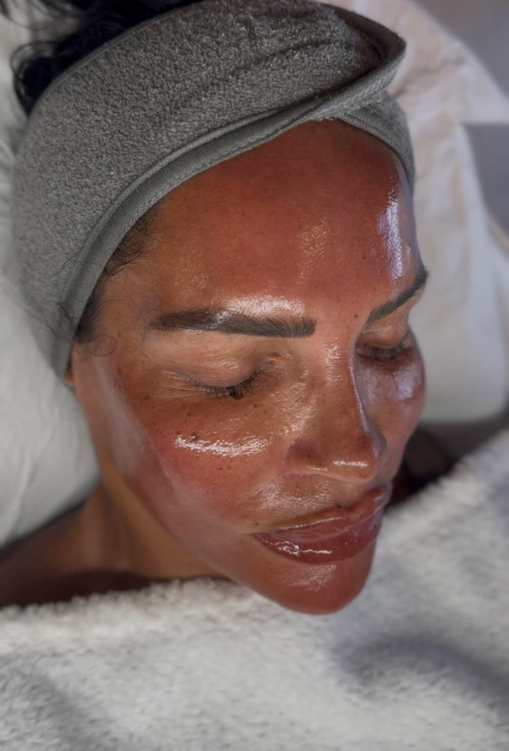 Microdermabrasion + Peel & Dermaplane