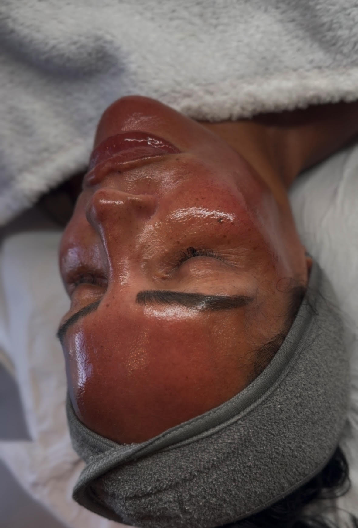 Microdermabrasion + Peel & Dermaplane