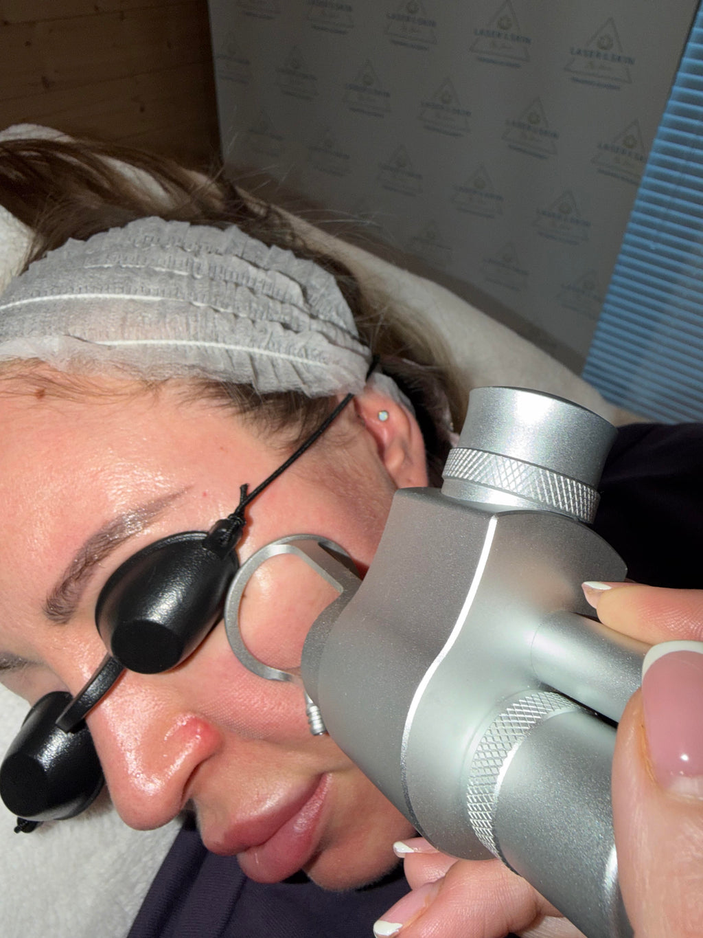 CO2 Fractional Laser Resurfacing
