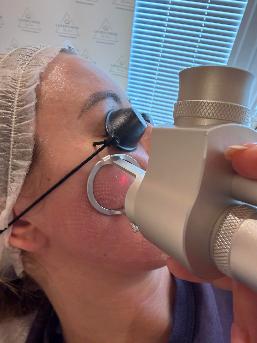 CO2 Fractional Laser Resurfacing