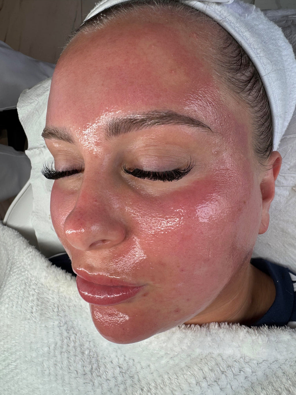 Microneedling + chemical peel/booster/exosomes