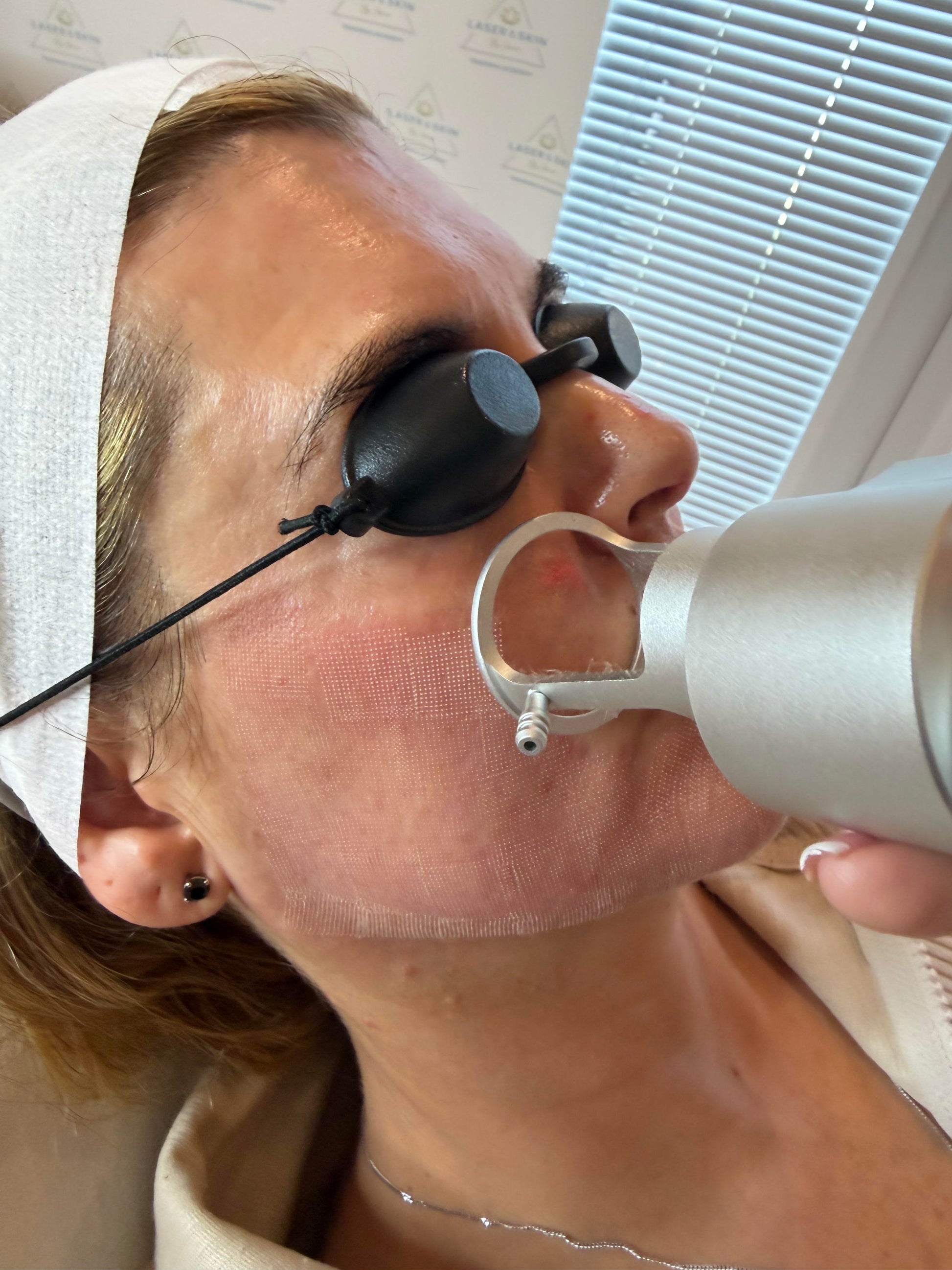 CO2 Fractional Laser Resurfacing